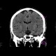 Early changes of brain ischemia, MCA: CT - Computed tomography